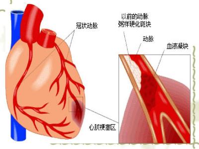 急性心梗的护理常规 急性心梗的急救护理