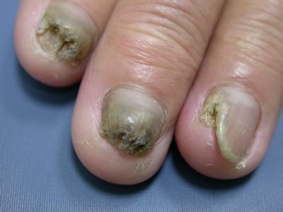 灰指甲最开始的症状 灰指甲症状