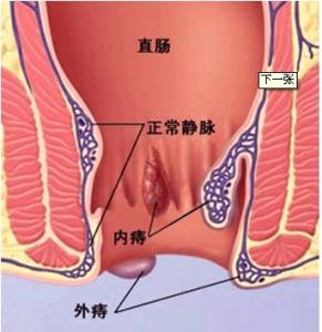 什么是痔疮早期图片 什么是痔疮？