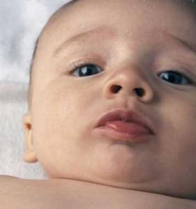 宝宝湿疹怎么护理 如何护理婴儿湿疹