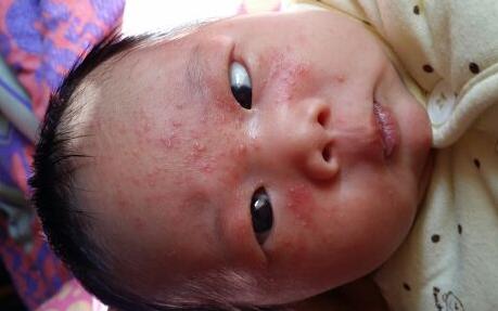 新生儿脸上湿疹怎么办? 新生儿湿疹该怎么办