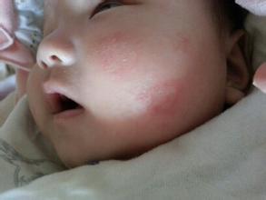 治疗过敏性皮炎的方法 宝宝过敏性皮炎的治疗方法