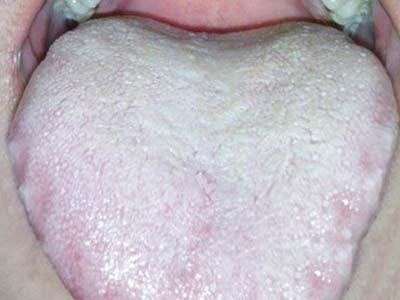 舌苔厚黄是怎么回事 舌苔厚白是怎么回事