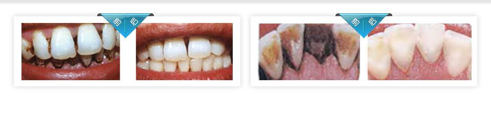 牙缝变大是什么原因 牙缝变大怎么办？牙缝变大的原因