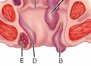 痔疮图片女性早期图片 痔疮可以自愈吗