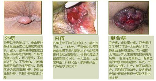 得痔疮了该怎么办 得了痔疮要怎么办