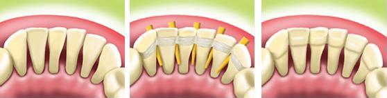 牙齿松动的8种治疗方法 牙齿松动了怎么办