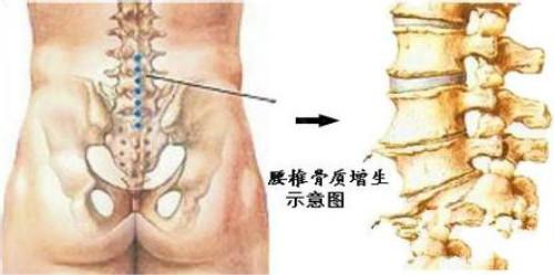 治腰椎骨质增生的方法 腰椎骨质增生怎么办_腰椎骨质增生的解决方法