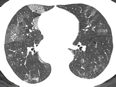 间质性肺炎病理改变 什么是肺间质性改变 什么是间质性肺炎
