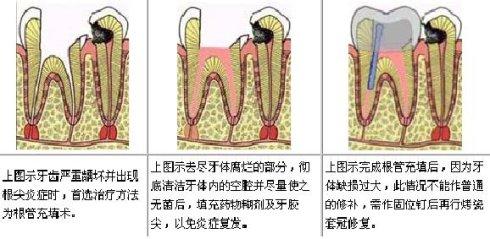 根管治疗过程 什么是根管治疗术 根管治疗术过程