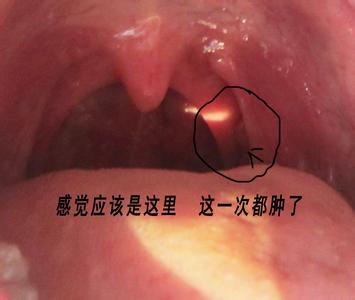 喉咙有异物感怎么办 喉咙里有异物怎么办_喉咙里有异物的解决方法