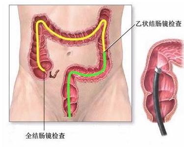 结肠直肠癌 什么是结肠直肠癌 结肠直肠癌病因 结肠直肠癌治疗