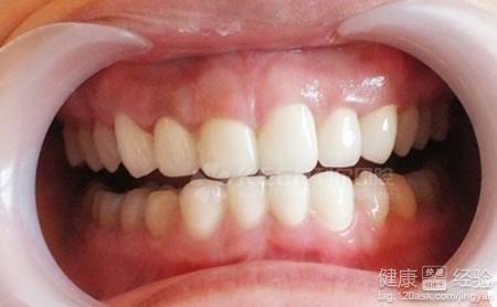 牙龈萎缩的治疗方法 哪些窍门能治牙龈萎缩