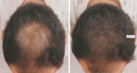 油脂性脱发的治疗 油脂性脱发原因_治疗油脂性脱发的最佳方法