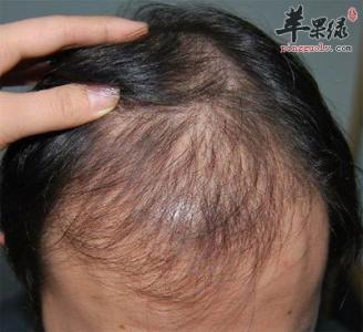 常见的男性脱发的原因 脱发常见4大原因和特点