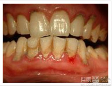 牙周炎吃什么药 牙周炎吃什么药_牙周炎发生的原因是什么