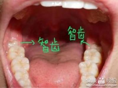 牙龈肿痛能吃什么食物 长智齿牙龈肿痛可以吃什么