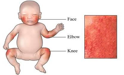 医治婴儿期异位性皮炎 婴儿异位性皮肤炎怎么办