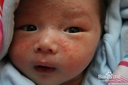 湿疹恢复期有什么表现 孩子得了湿疹有什么表现呢？