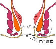 治疗肛门瘙痒偏方大全 肛门瘙痒怎么办