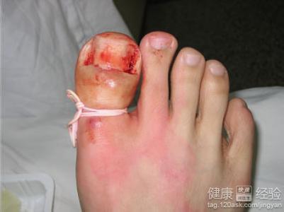 大脚趾灰指甲怎么治 脚趾甲沟炎怎么治