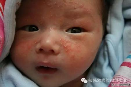 小儿过敏性湿疹 什么是小儿过敏性湿疹