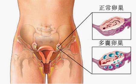 多卵巢综合征怎么引起 多囊卵巢综合症是怎么回事