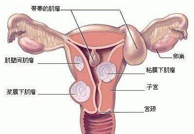 未婚子宫肌瘤怎么办 未婚有子宫肌瘤该怎么办