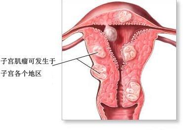 子宫肌瘤会不会癌变 子宫肌瘤多大需要手术