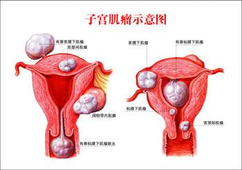 子宫肌瘤症状图片 子宫肌瘤早期症状