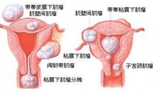 粘膜下子宫肌瘤怎么治 子宫肌瘤的症状及治疗方法