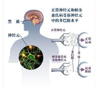 帕金森病原因 哪些原因会导致帕金森病