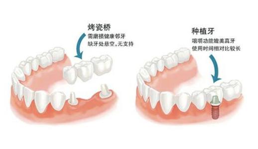 种植牙能用一辈子吗 种植牙的利与弊