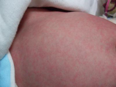 新生儿有红疹怎么办 新生儿红疹是怎么回事