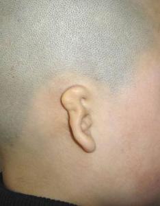 先天性耳朵畸形治疗 耳朵先天畸形怎么回事