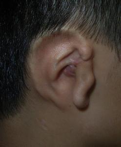 先天性耳朵畸形治疗 耳朵先天畸形的治疗