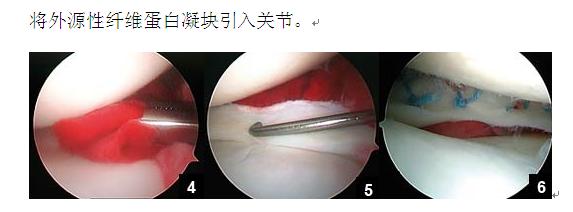 治疗半月板损伤方法 半月板损伤的怎么治疗_半月板损伤的有效治疗方法