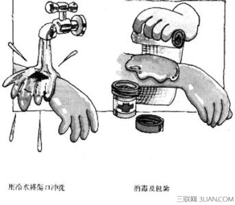 精油灼伤皮肤处理方法 烧伤灼伤的处理方法