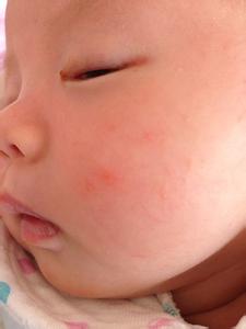 夏季湿疹 怎样解决夏季宝宝湿疹？
