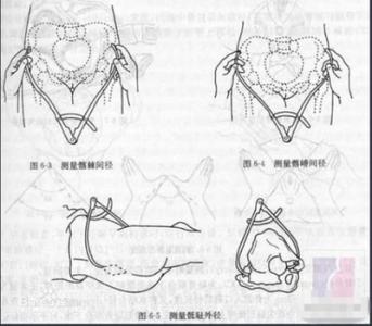 骨盆多大适合顺产 骨盆测量正常值