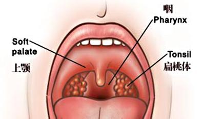 治疗咽喉炎有哪些方法 喉炎的急救方法有哪些