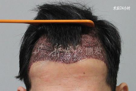脂溢性脱发植发有用吗 植发几年后还会脱发吗