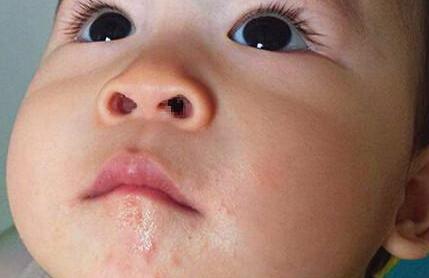 宝宝脸上有红痘痘 宝宝皮肤过敏有什么症状