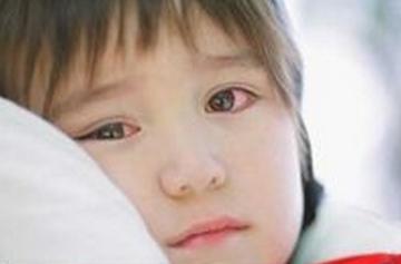 红眼病有哪些症状 宝宝红眼病症状有哪些