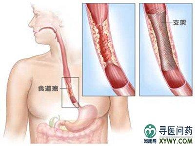 食道癌的临床表现 食道癌的治疗_食道癌的临床表现