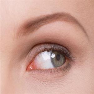 角膜炎的症状及图片 角膜炎和结膜炎的区别