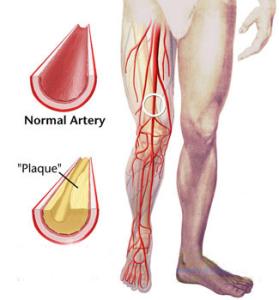 闭塞性动脉硬化症 远离动脉硬化症的妙招