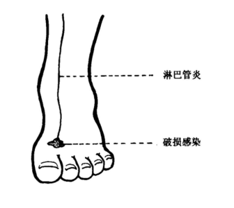 脚气不治会怎么样 脚气不治易发三种炎症