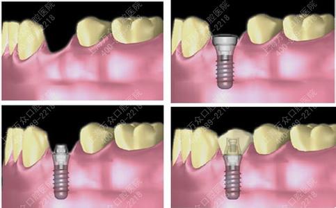 种植牙修复步骤 种植牙要哪些修复步骤?