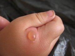 婴幼儿湿疹的病因 幼儿湿疹病因有哪些